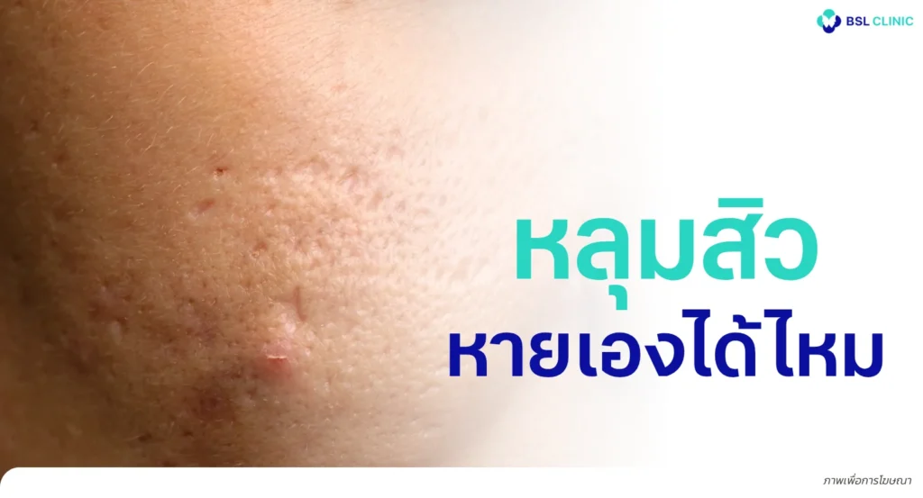 หลุมสิวหายเองได้ไหม? เจาะลึกความจริงเรื่องการฟื้นฟูพังผืดใต้ชั้นผิว