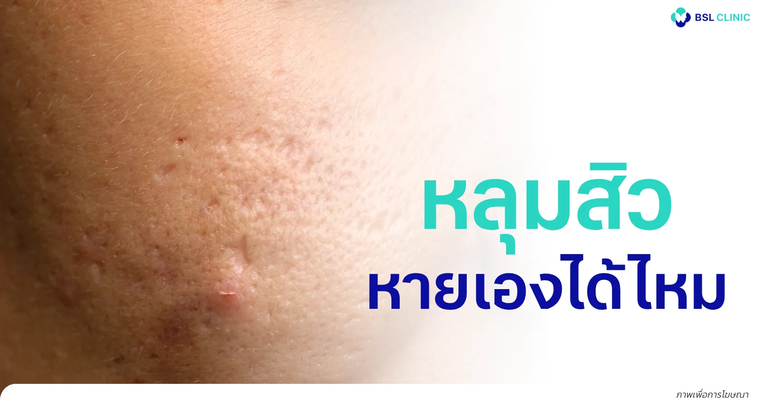 หลุมสิวหายเองได้ไหม