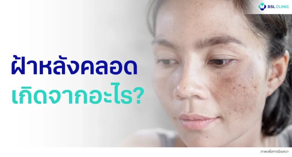 ฝ้าหลังคลอด