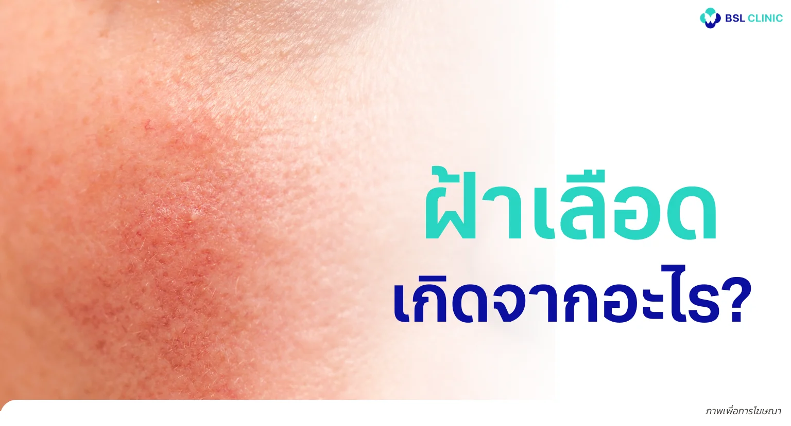 ฝ้าเลือด