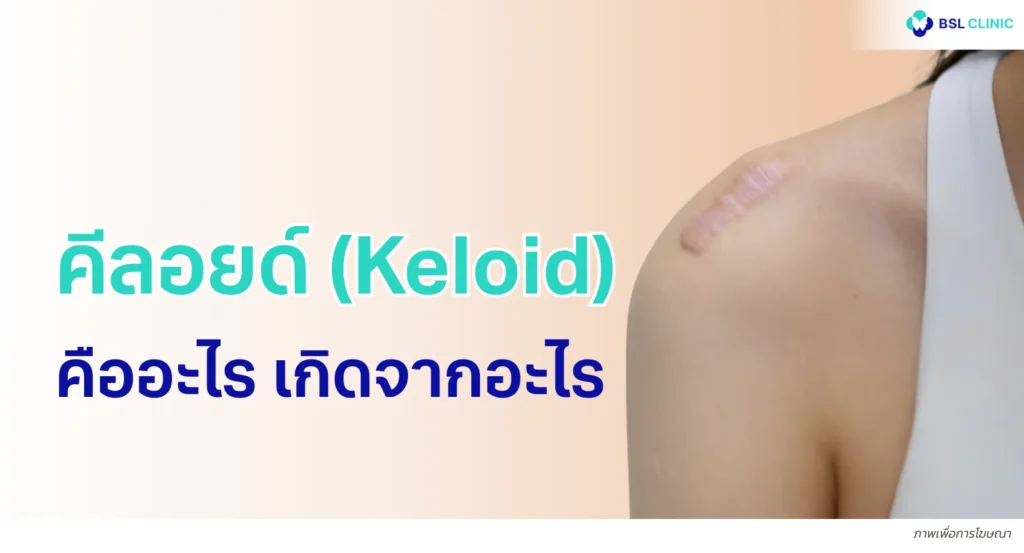 คีลอยด์