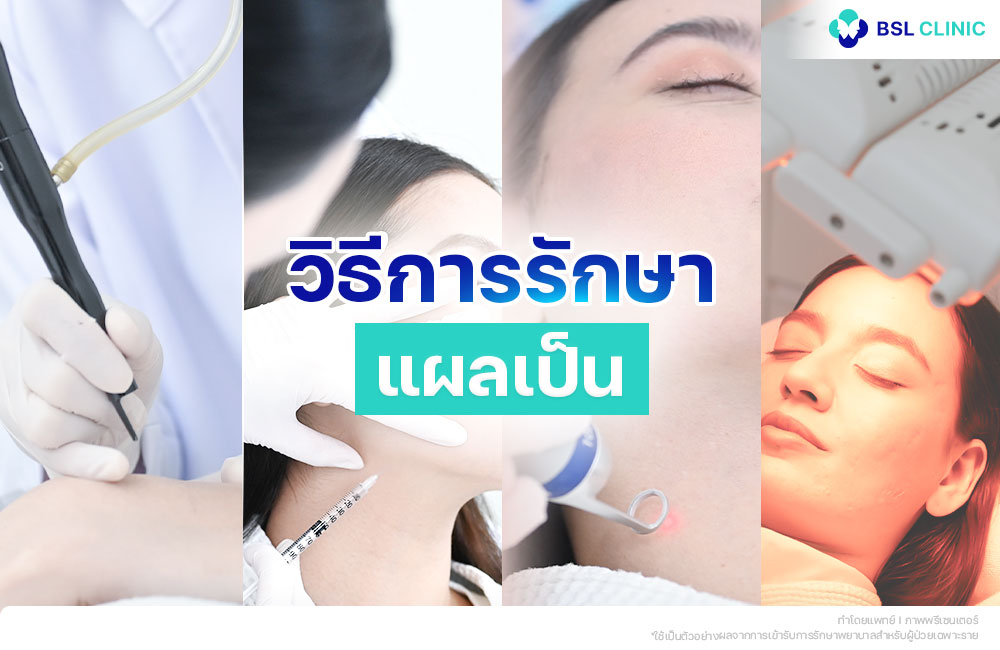 วิธีการรักษารอยแผลเป็น
