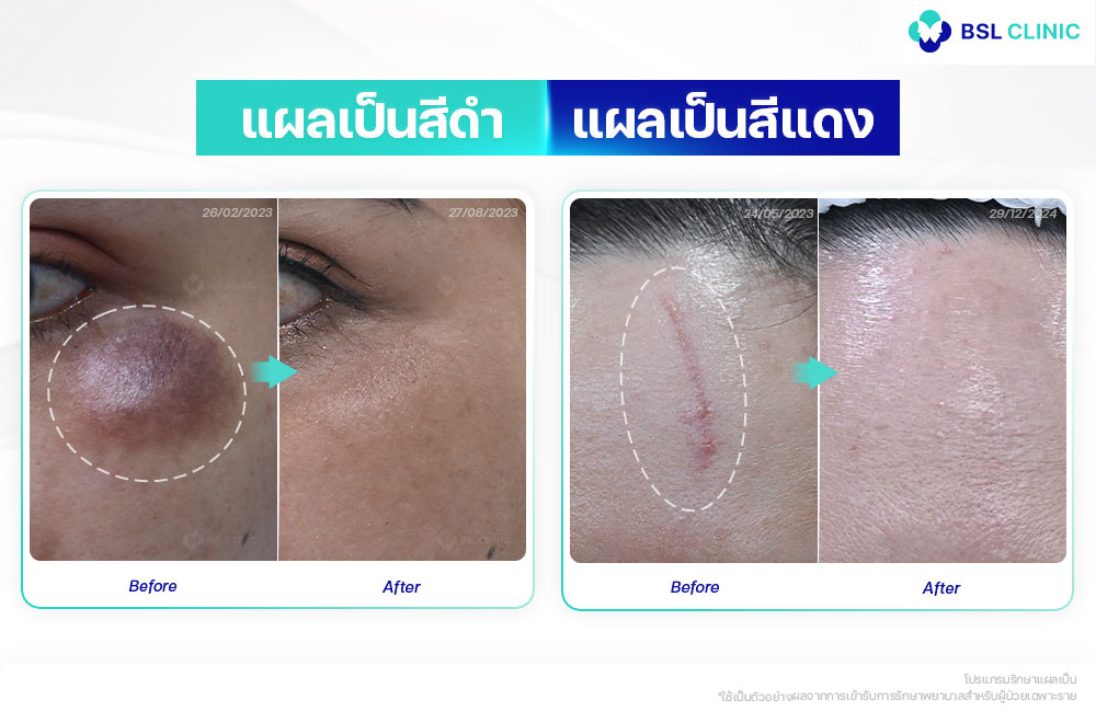 ลักษณะของแผลเป็น