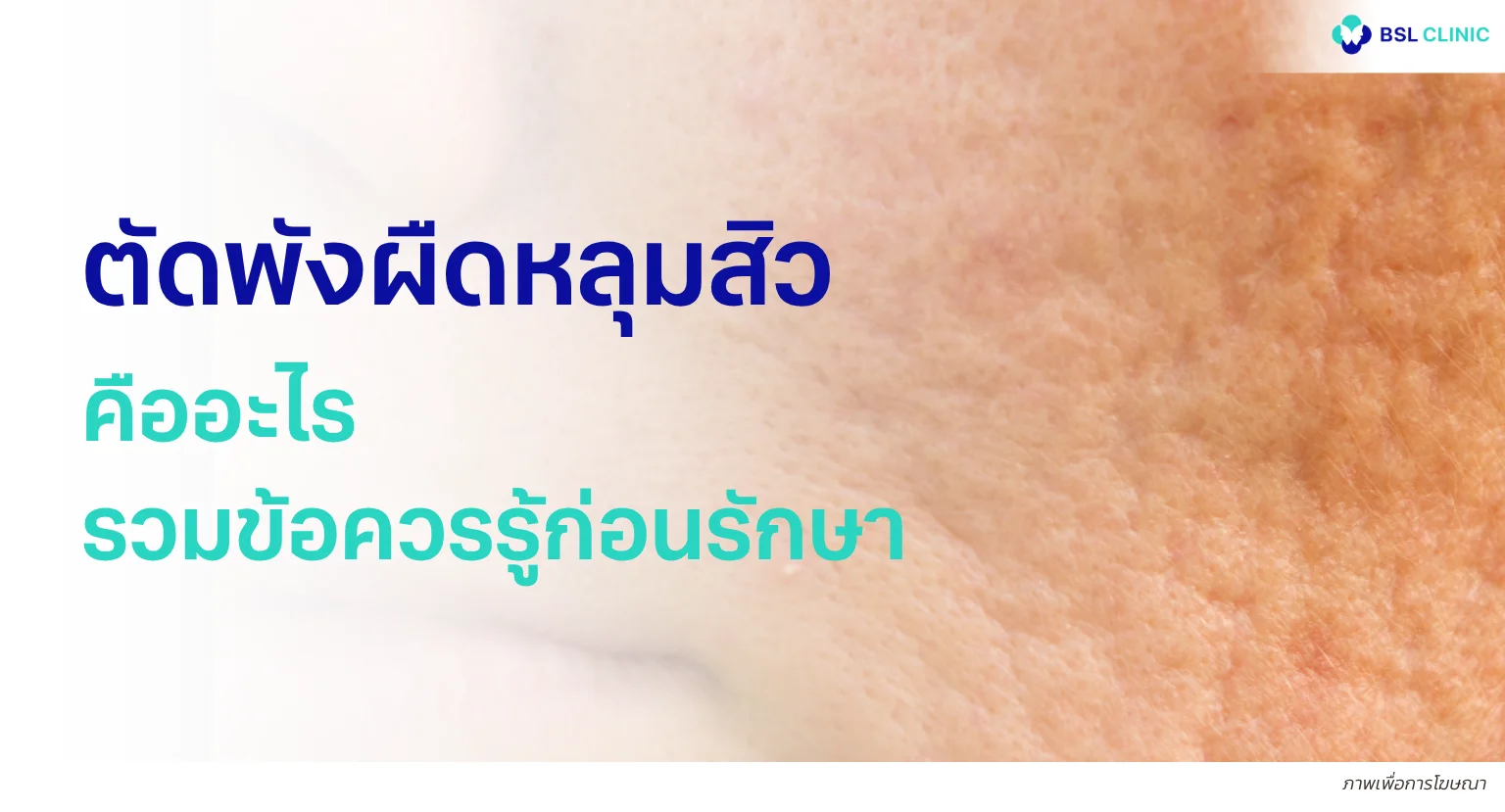 ตัดพังผืดหลุมสิว
