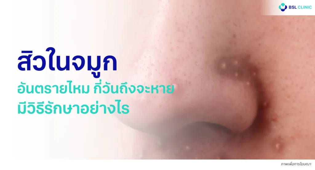 สิวในจมูก อันตรายไหม กี่วันถึงจะหาย มีวิธีรักษาอย่างไร