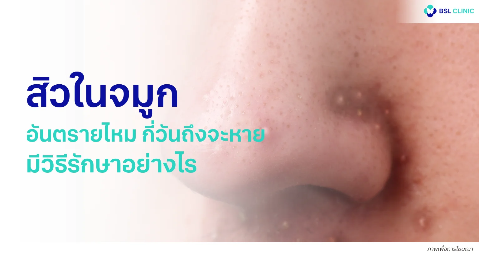 สิวในจมูก