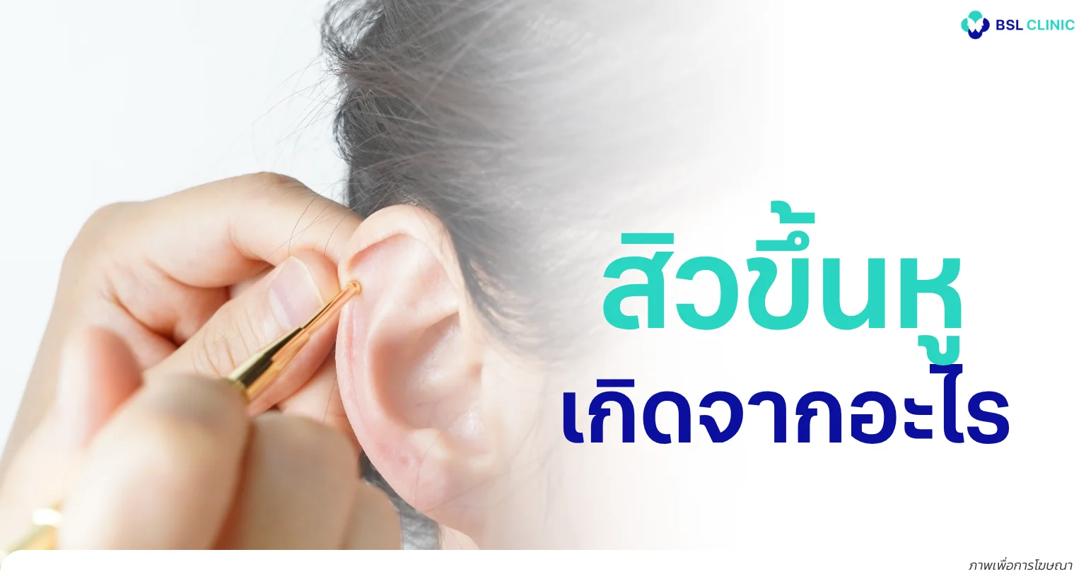 สิวขึ้นหู