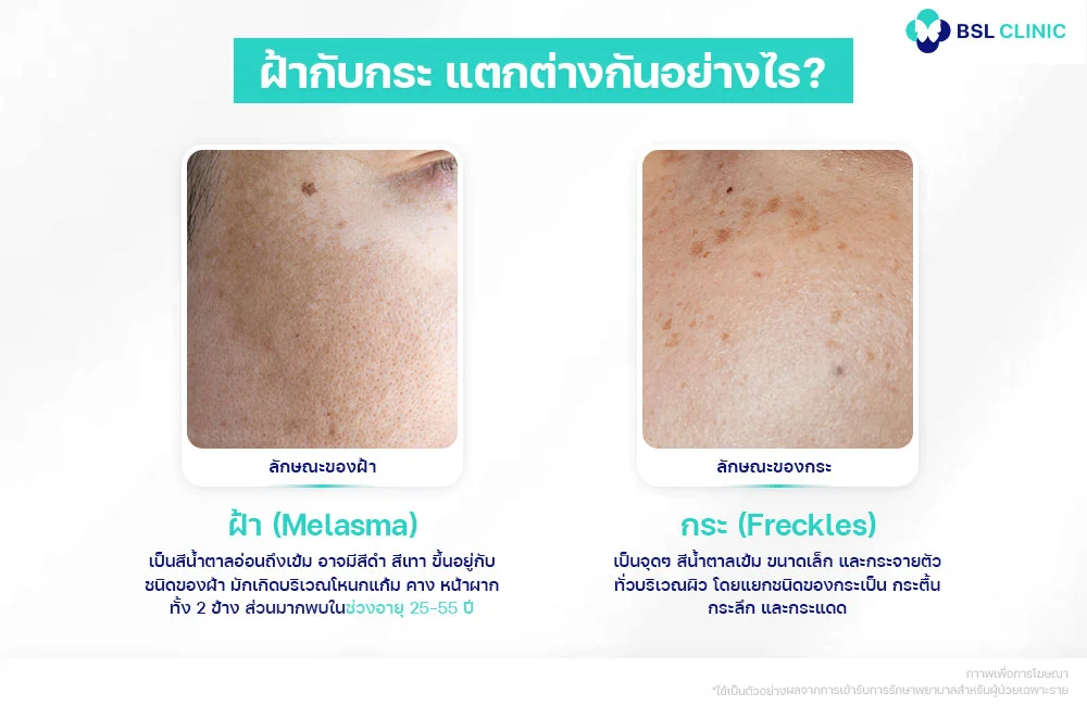 ฝ้ากับกระต่างกันยังไง