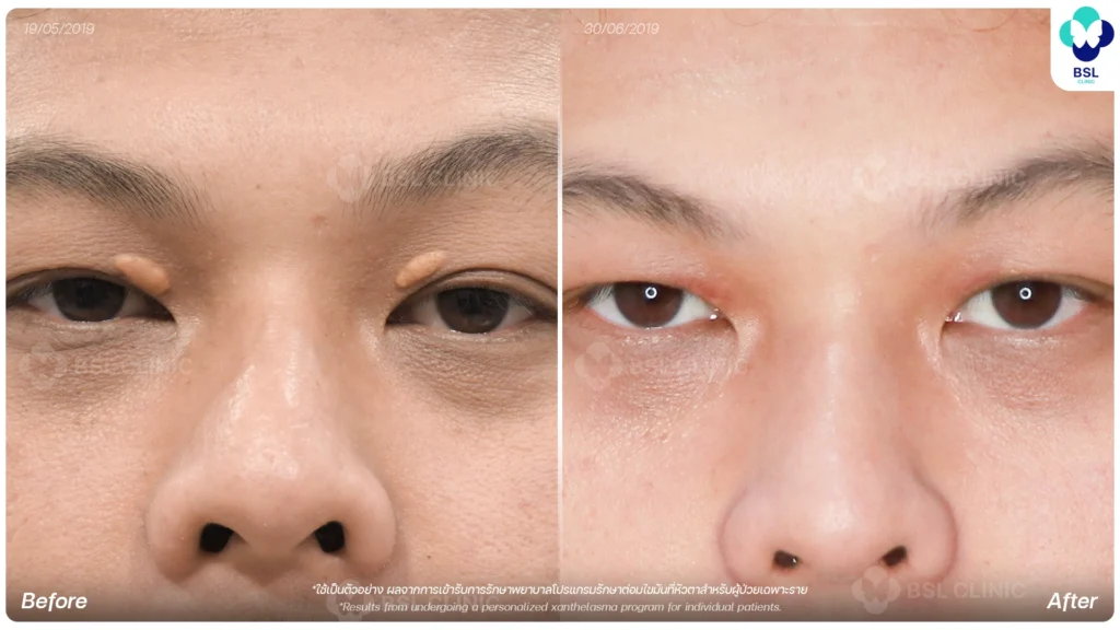 before after results moles