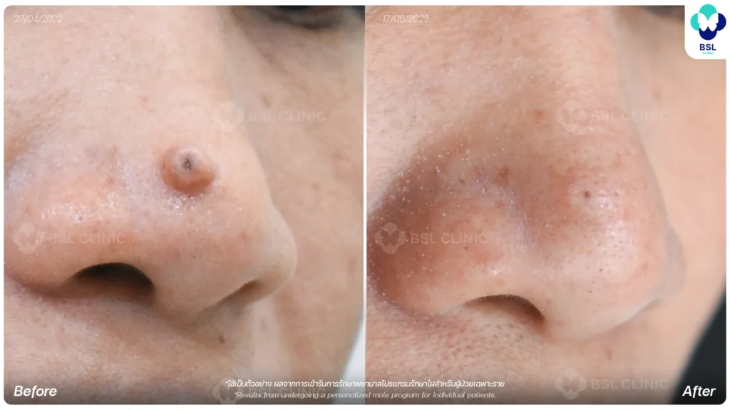 before after results moles
