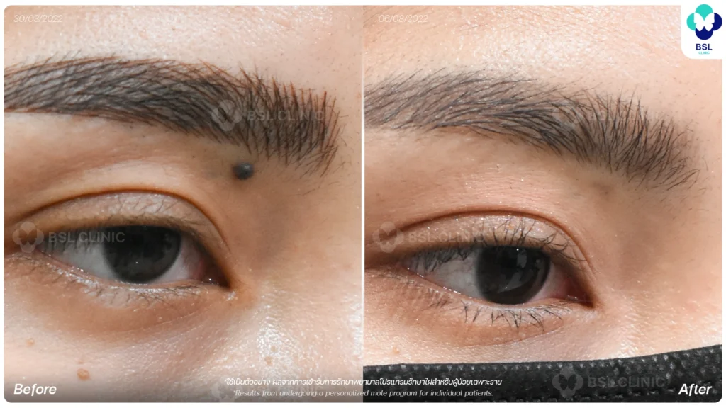 CO2 Mole Treatment