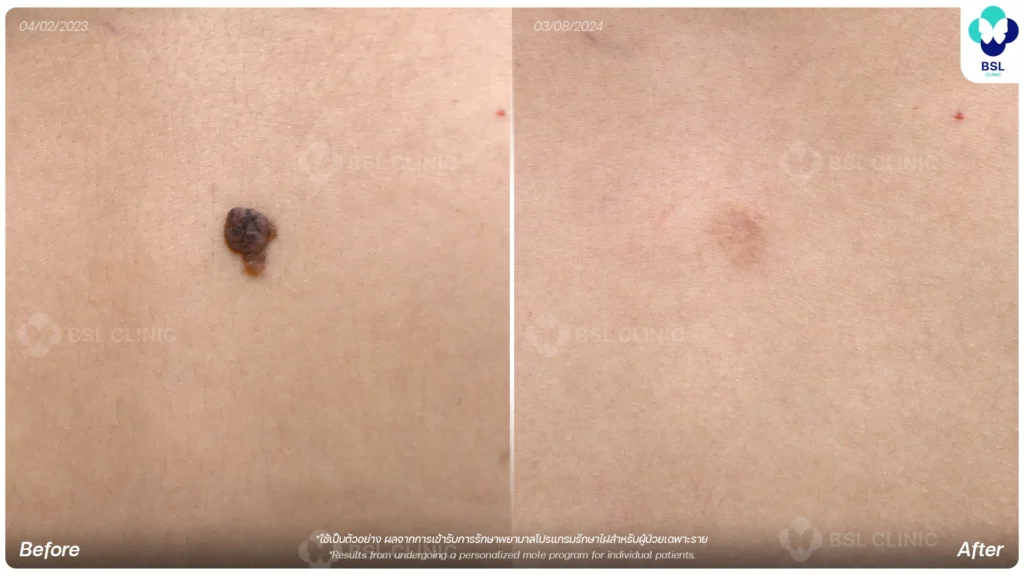 before after results moles