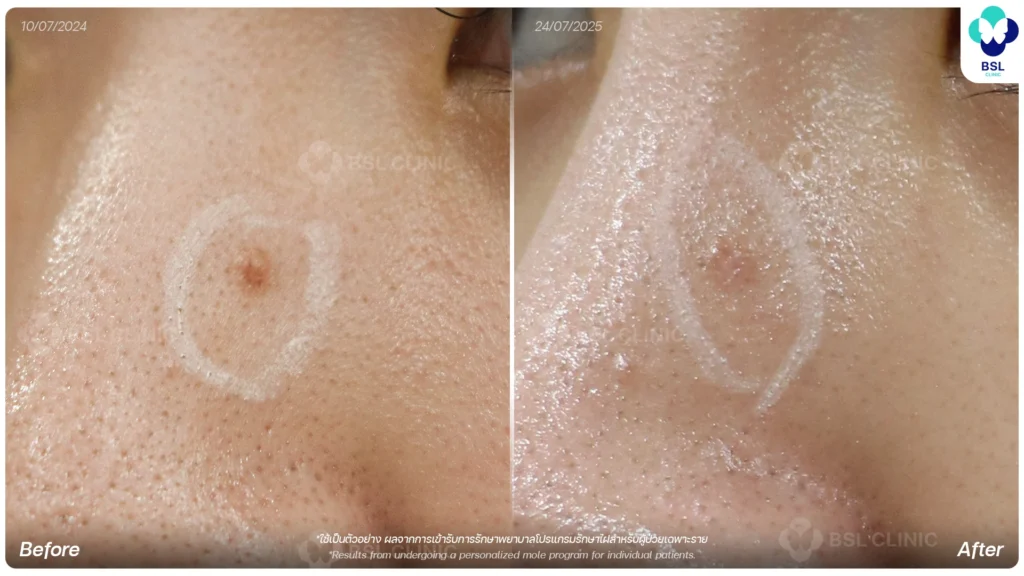 before after results moles