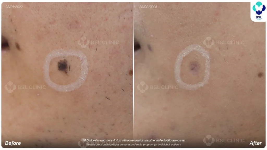 before after results moles