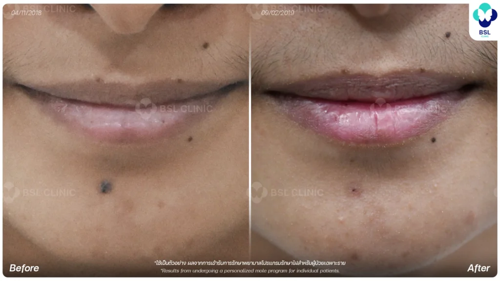 before after results moles