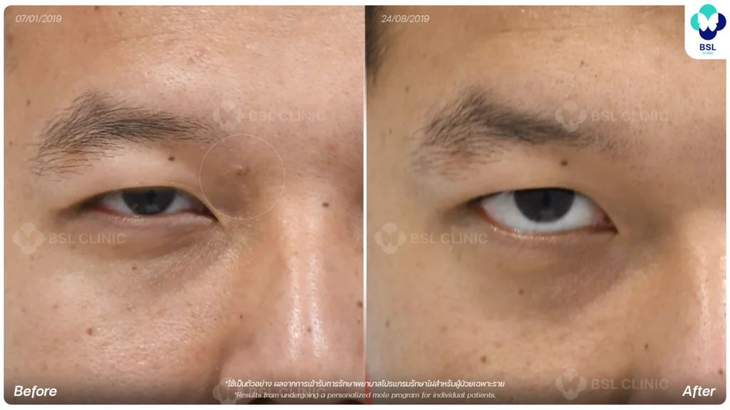before after results moles