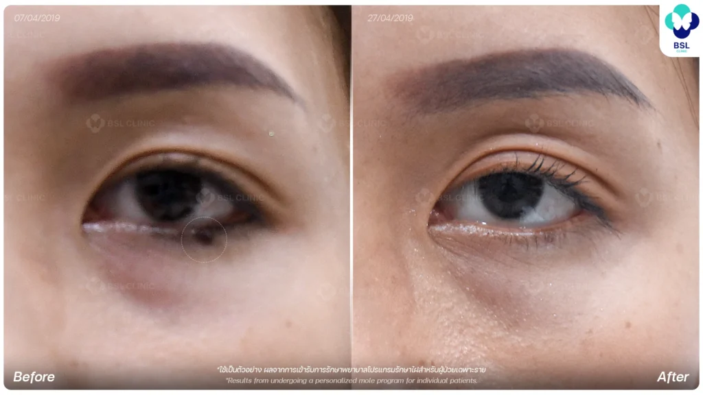 before after results moles