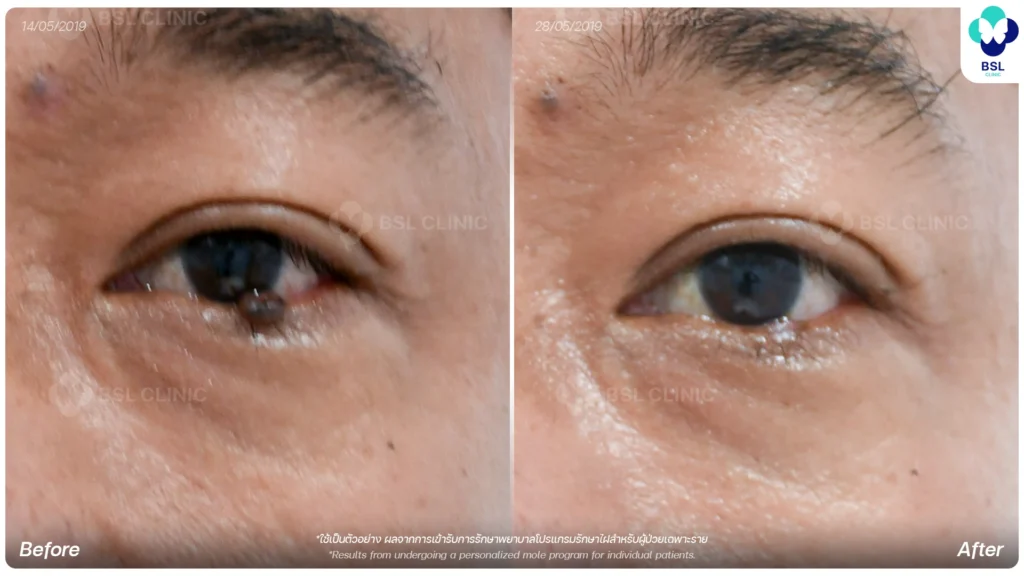 before after results moles