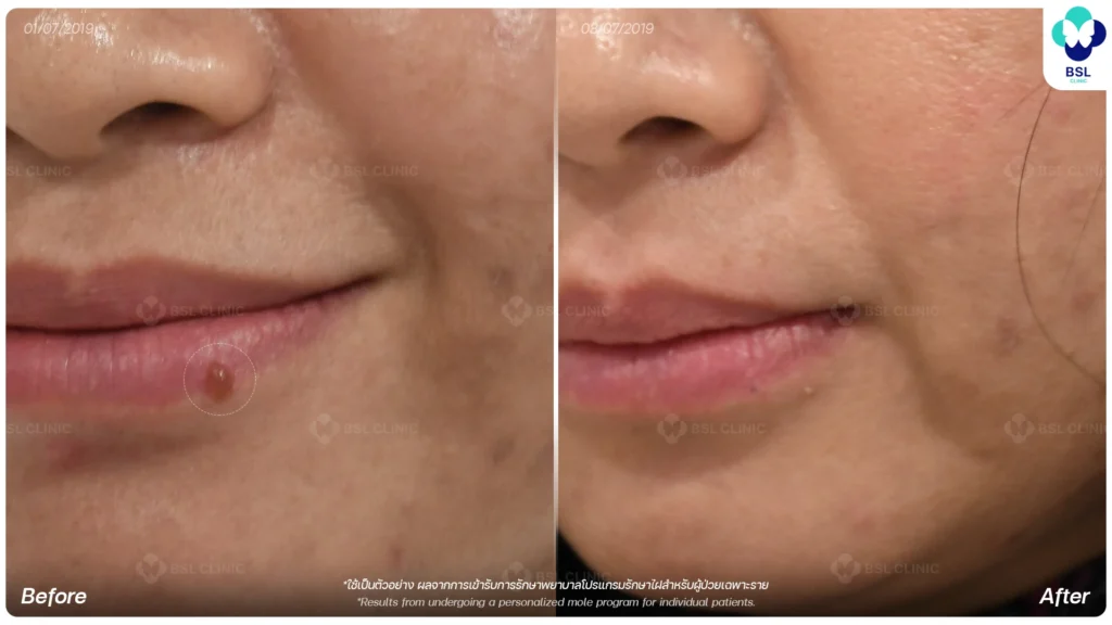 before after results moles
