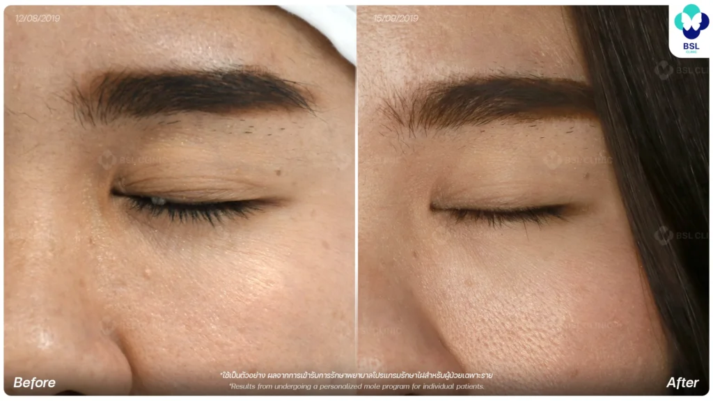 before after results moles