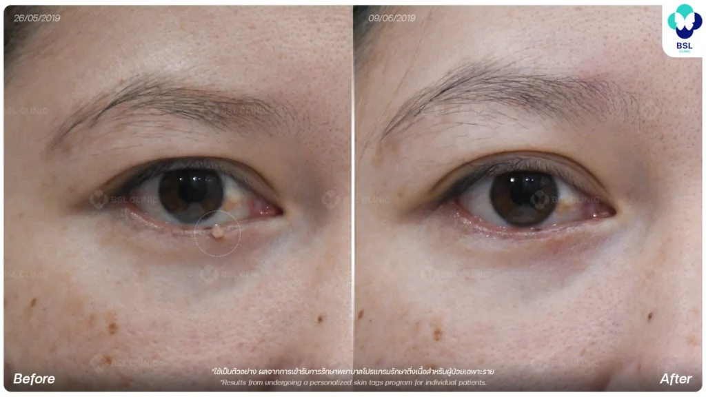 CO2 Mole Treatment-BA-620376-L_ศิริลักษณ์