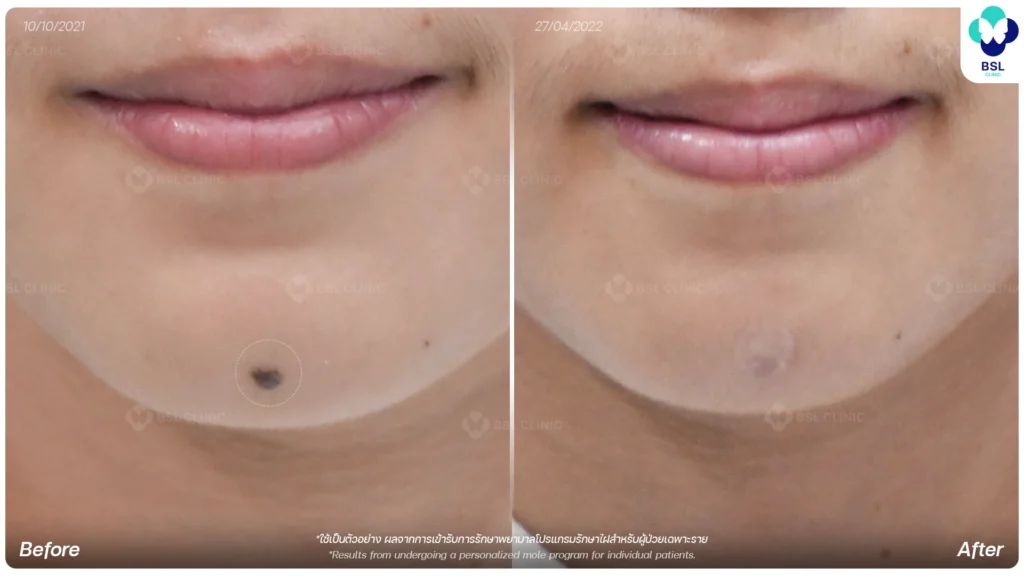 before after results moles