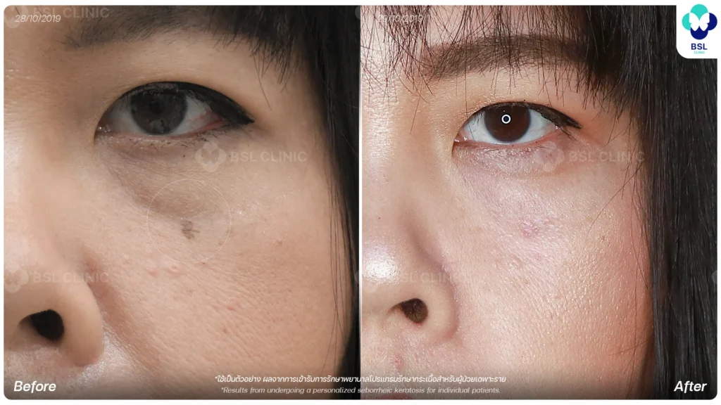 before after results moles