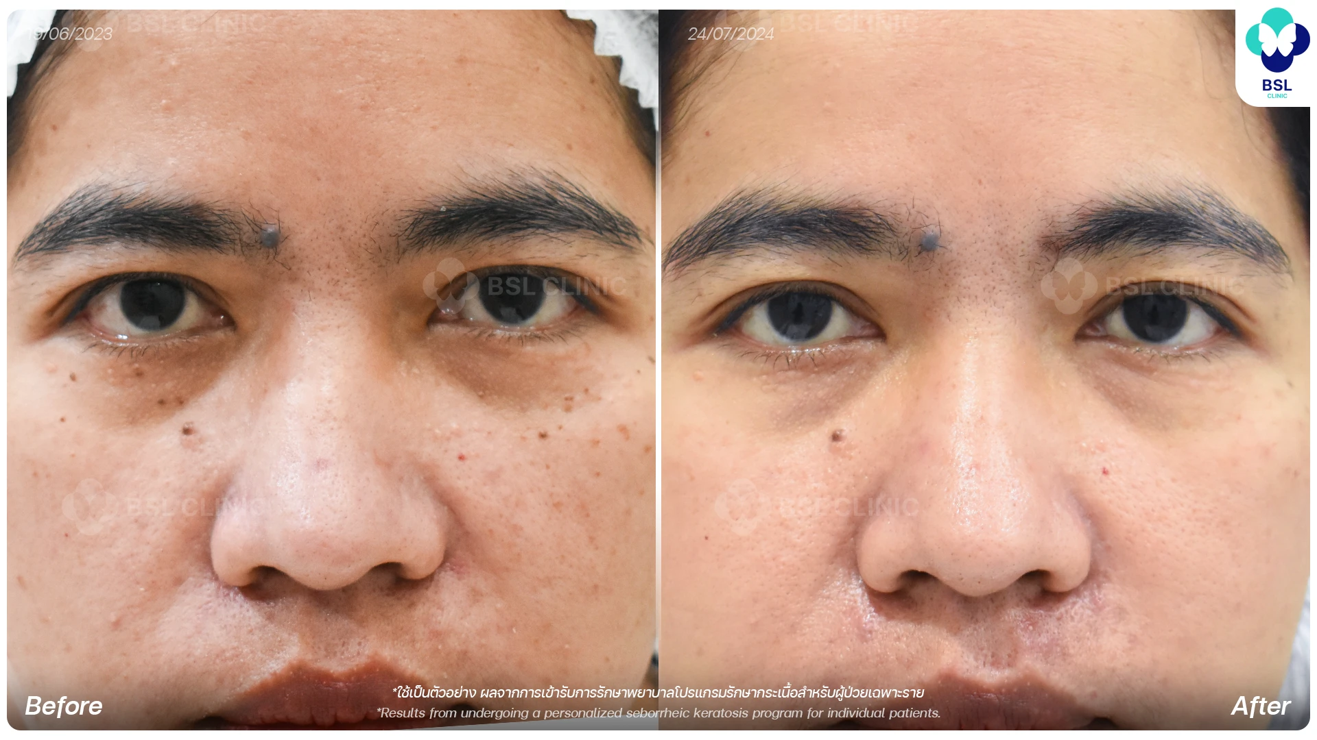 CO2 Mole Treatment-กระเนื้อ