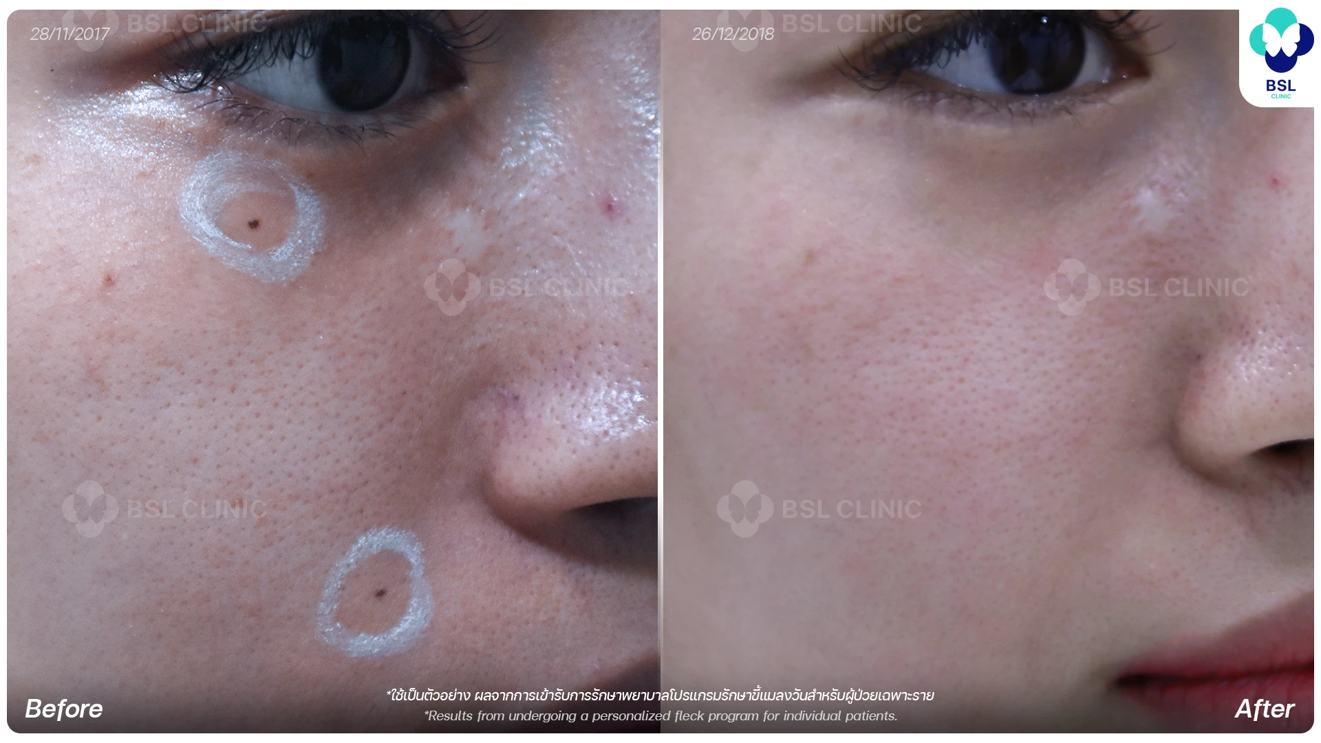 CO2 Mole Treatment-ขี้แมลงวัน