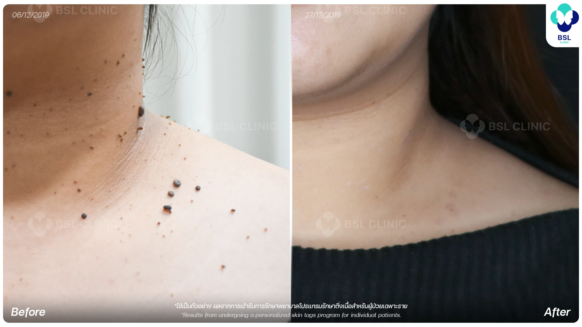 CO2 Mole Treatment-ติ่งเนื้อ