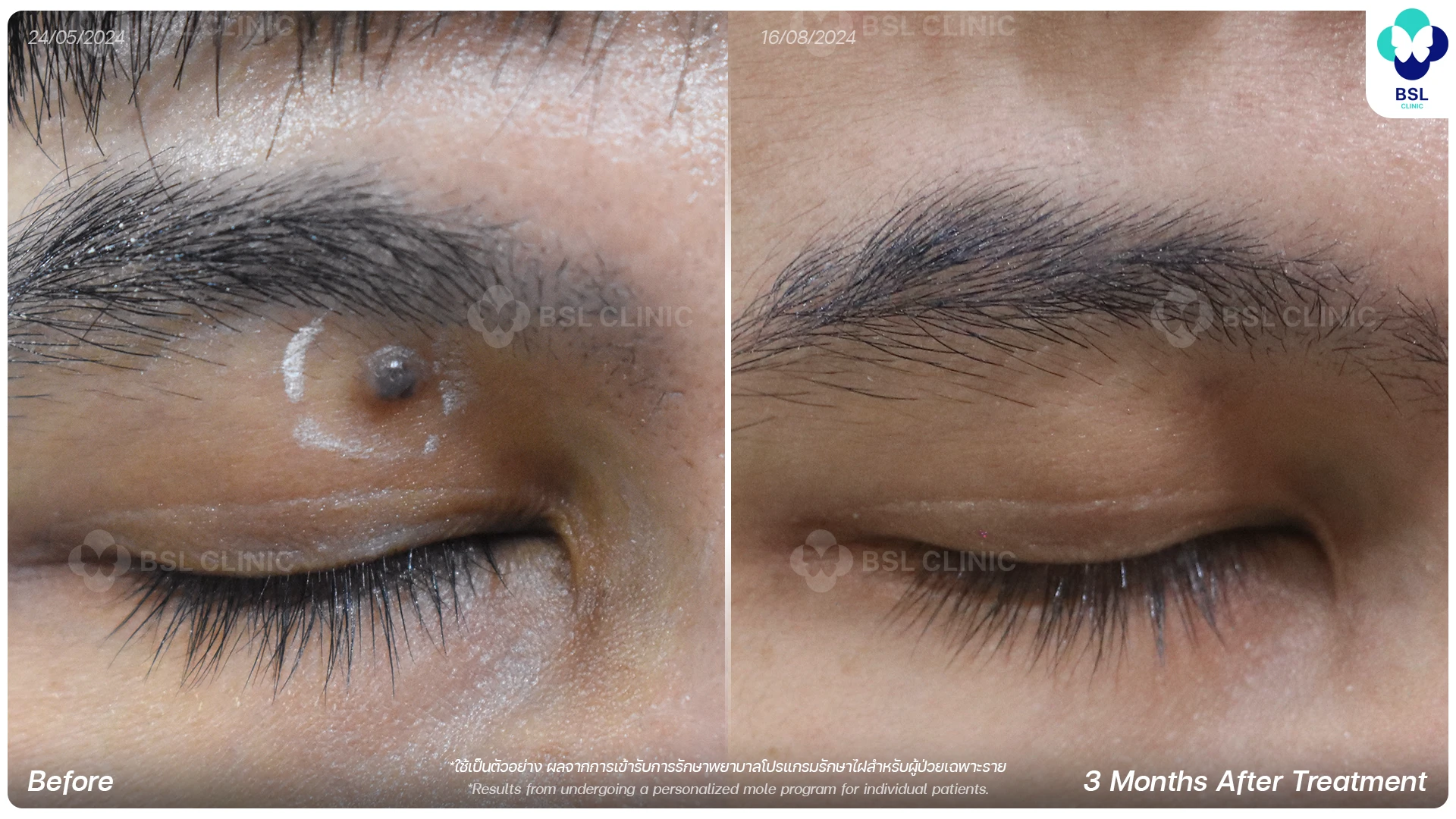 CO2 Mole Treatment-ไฝ