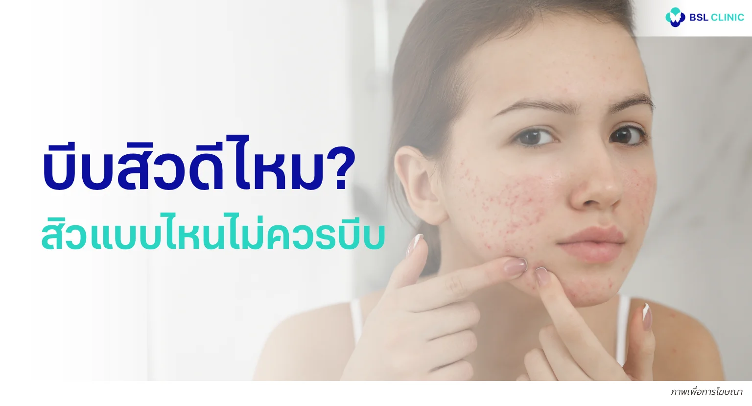บีบสิวดีไหม