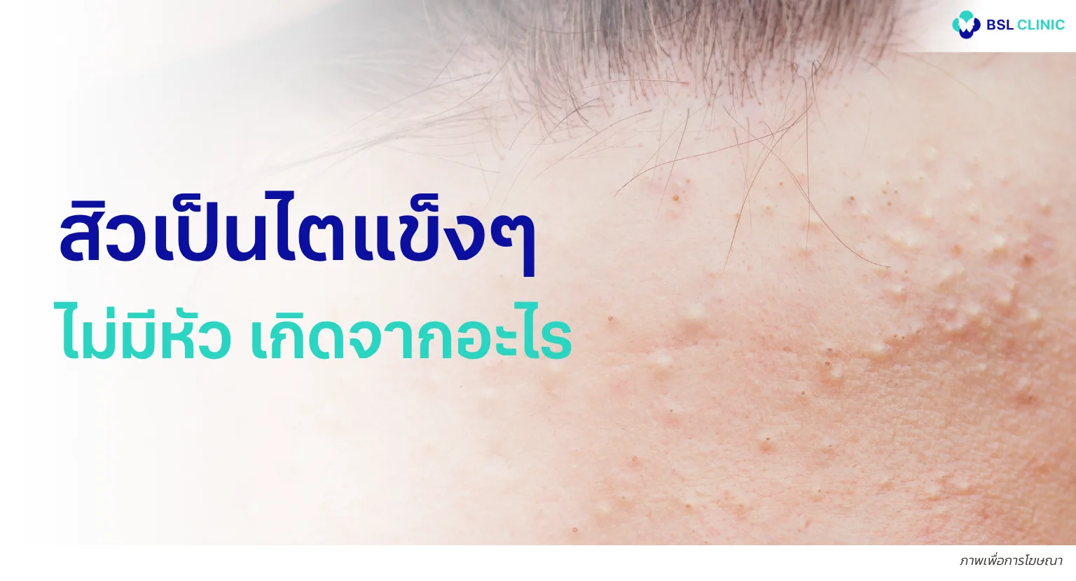 สิวเป็นไต