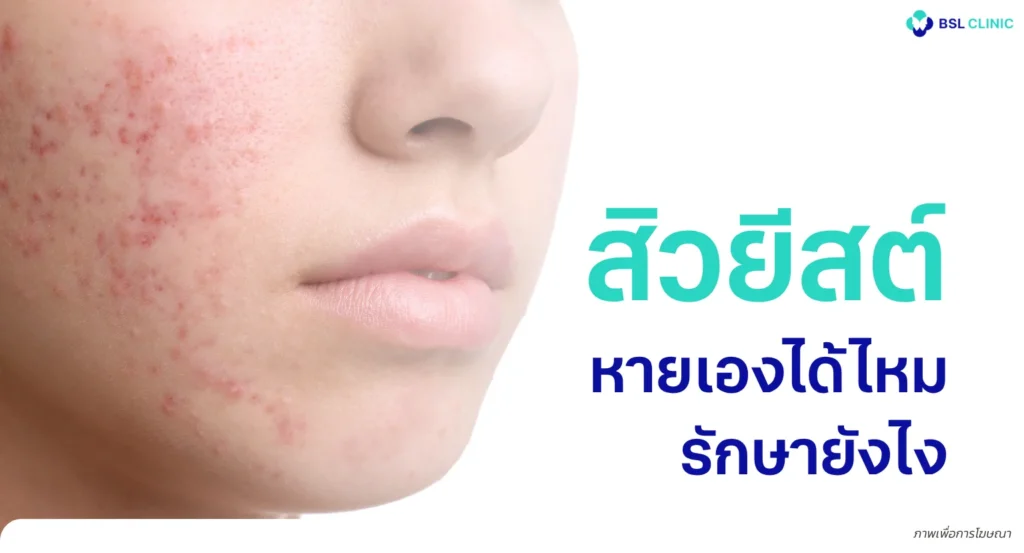 สิวยีสต์