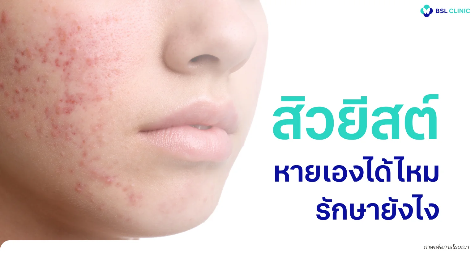 สิวยีสต์