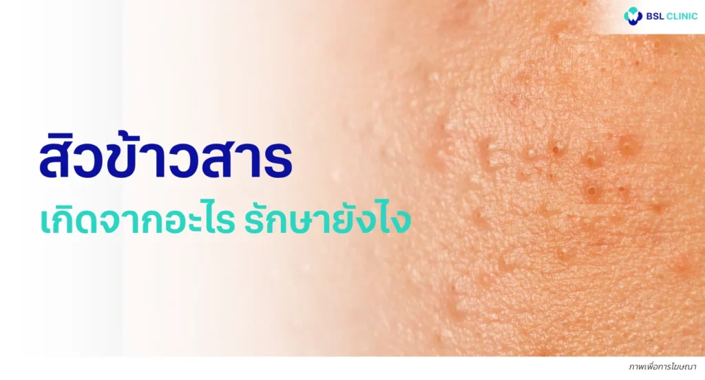 สิวข้าวสาร
