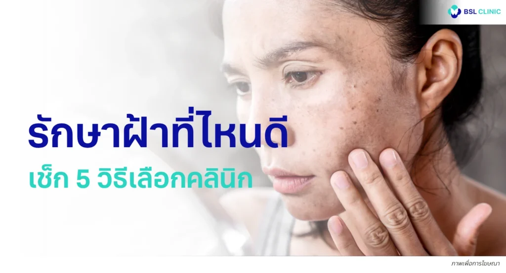 รักษาฝ้าที่ไหนดี