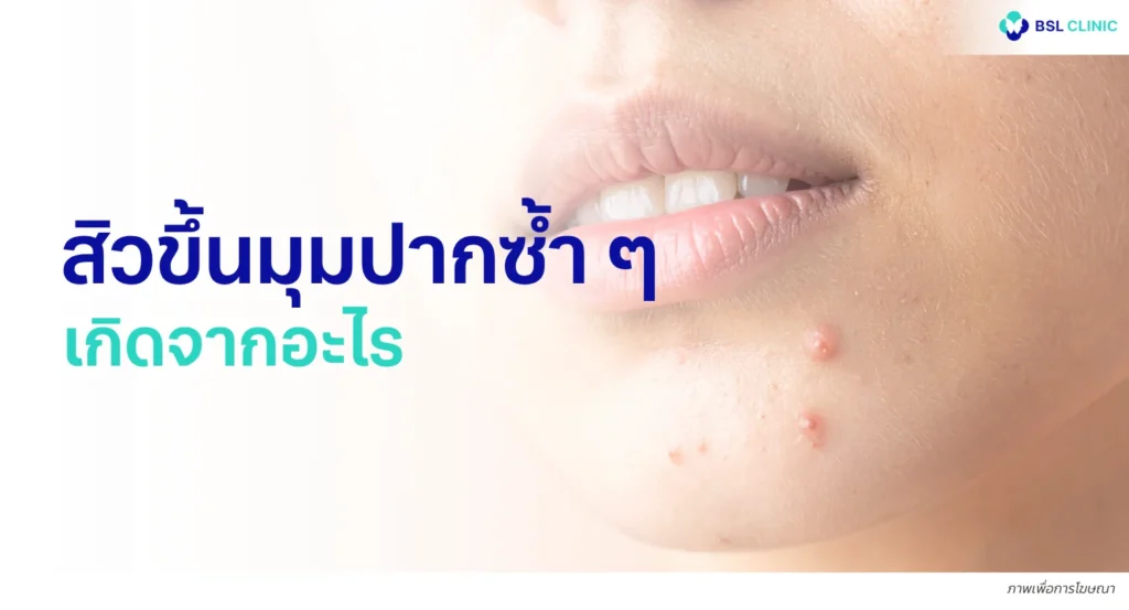 สิวมุมปาก