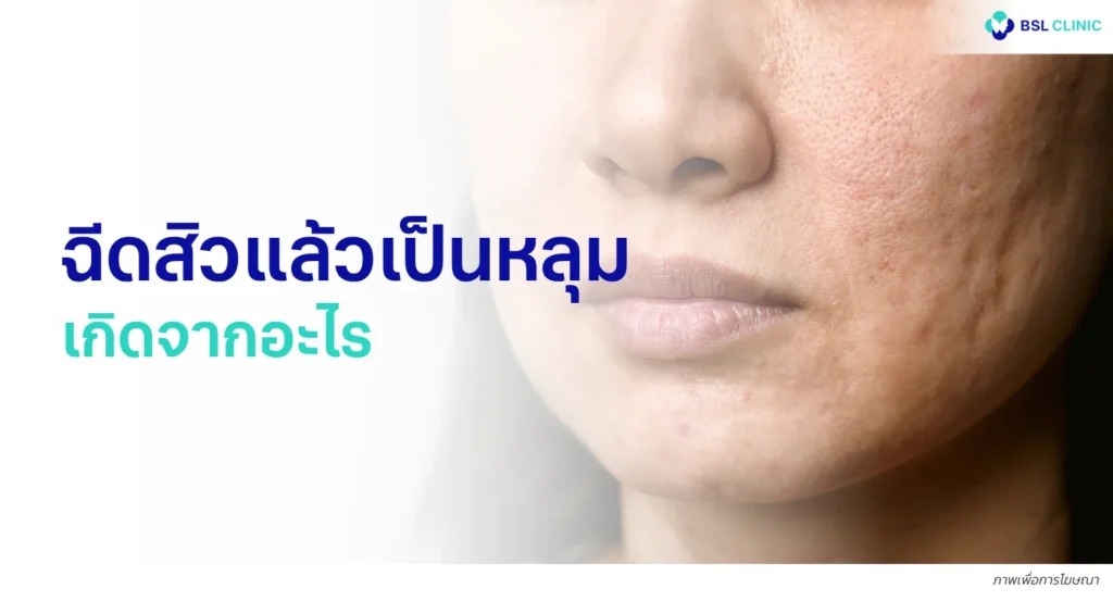 ฉีดสิวแล้วเป็นหลุม