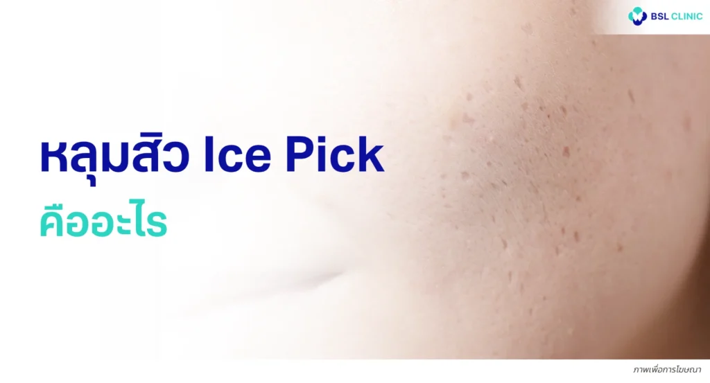 หลุมสิว Ice Pick