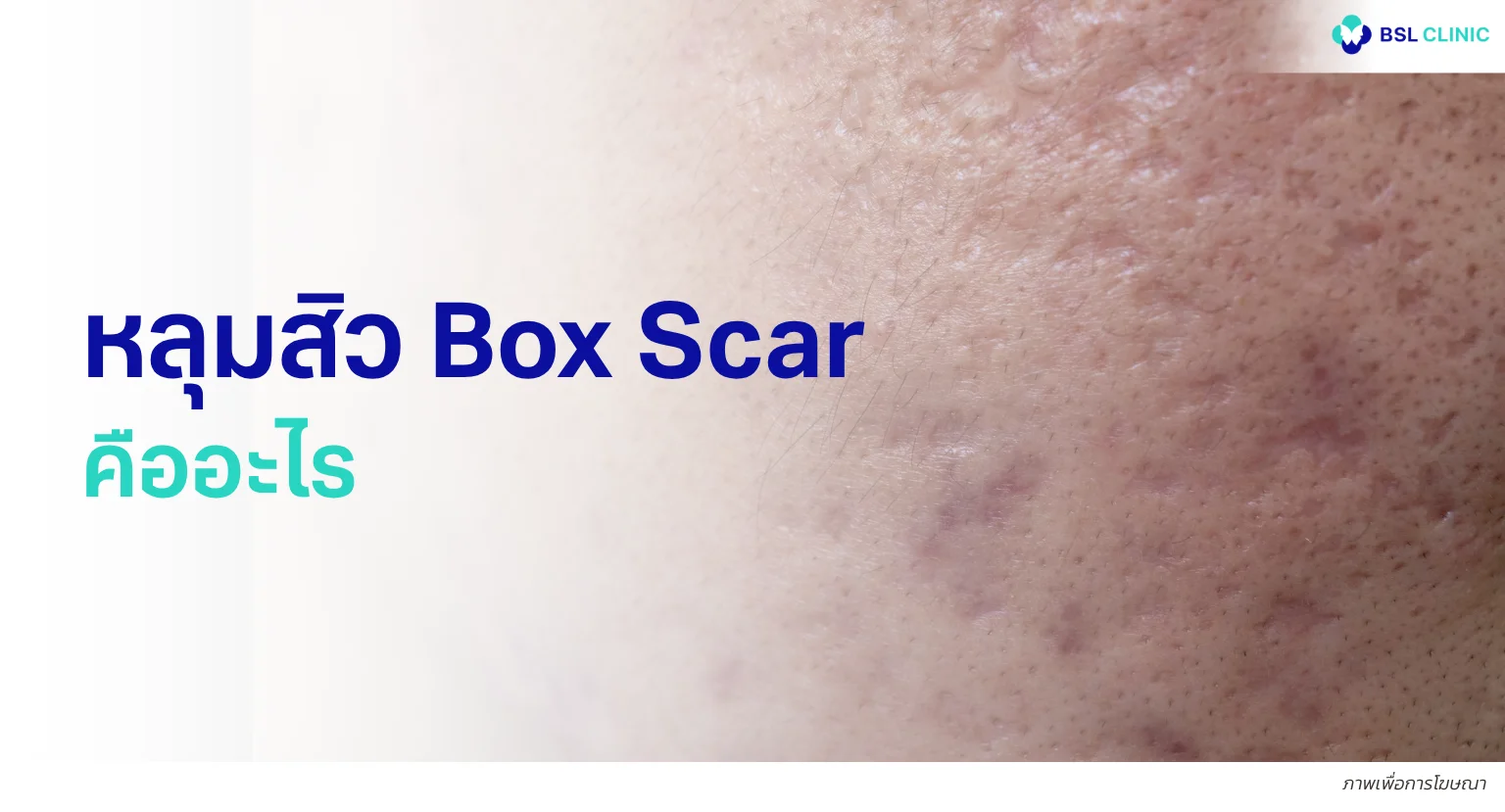 หลุมสิว Box Scar