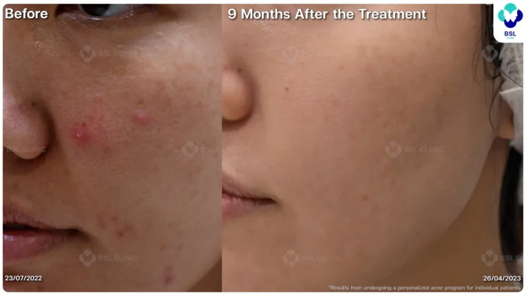 รีวิวรักษาหลุมสิว Ice Pick Scar ที่ BSL Clinic