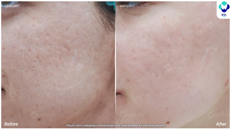 รีวิวรักษาหลุมสิว Box Scar ที่ BSL Clinic