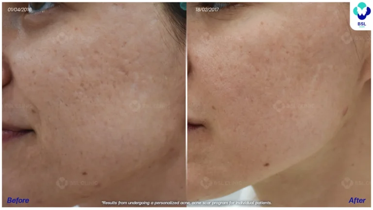 รีวิวรักษาหลุมสิวที่ BSL Clinic