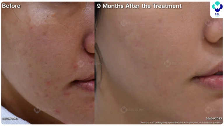 รีวิวรักษาหลุมสิว Ice Pick Scar ที่ BSL Clinic