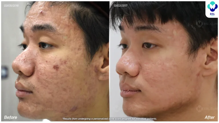 รีวิวรักษาหลุมสิว Box Scar ที่ BSL Clinic