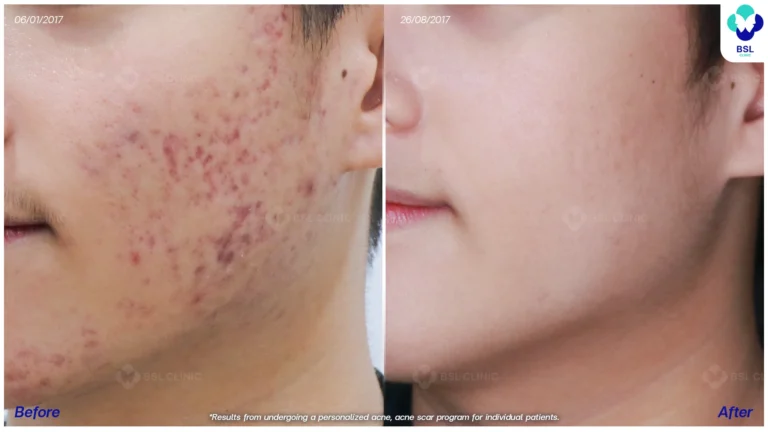 รีวิวรักษาหลุมสิวที่ BSL Clinic