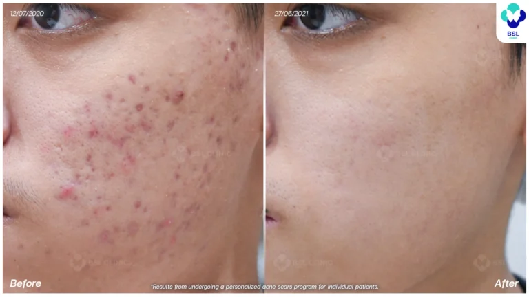 รีวิวรักษาหลุมสิว Box Scar ที่ BSL Clinic