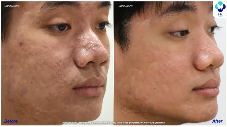 รีวิวรักษาหลุมสิวที่ BSL Clinic