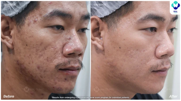 รีวิวรักษาหลุมสิว Box Scar ที่ BSL Clinic